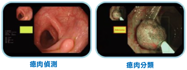 息肉偵測/息肉分類