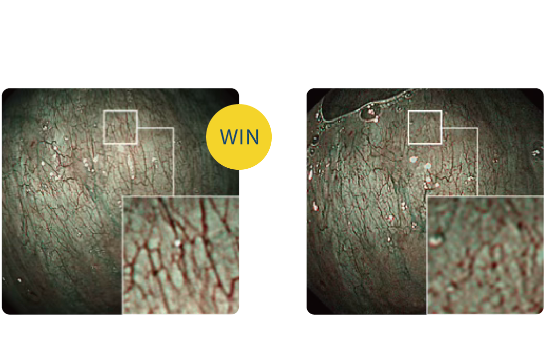 NBI進階觀察